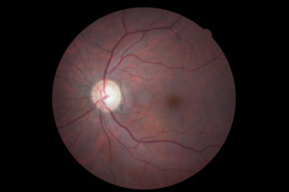 exame-retinografia-2